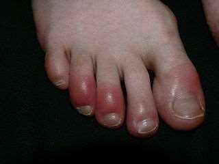 Chilblains on the toes